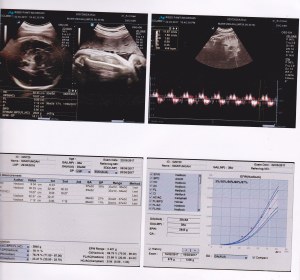 [Pregnancy Diary]Ketika HPL HPHT berbeda dengan HPL USG 